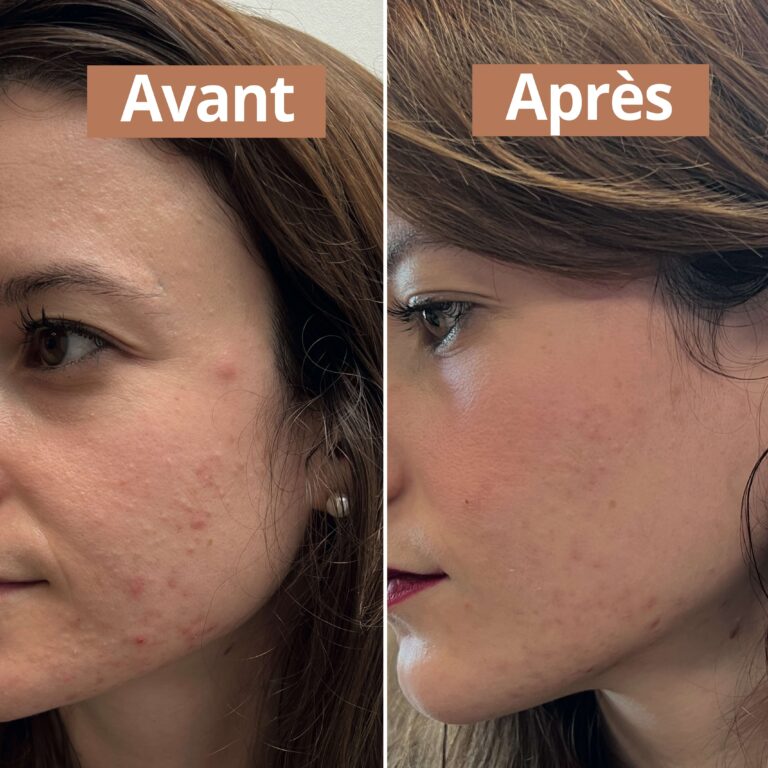 Comme Avant - Routine soin peaux à imperfections