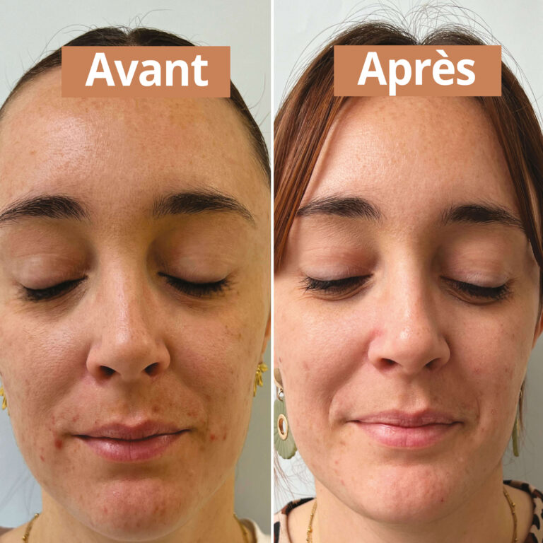 Comme Avant - Sérum visage purifiant - Version 1 – 1 recharge de sérum - 30ml